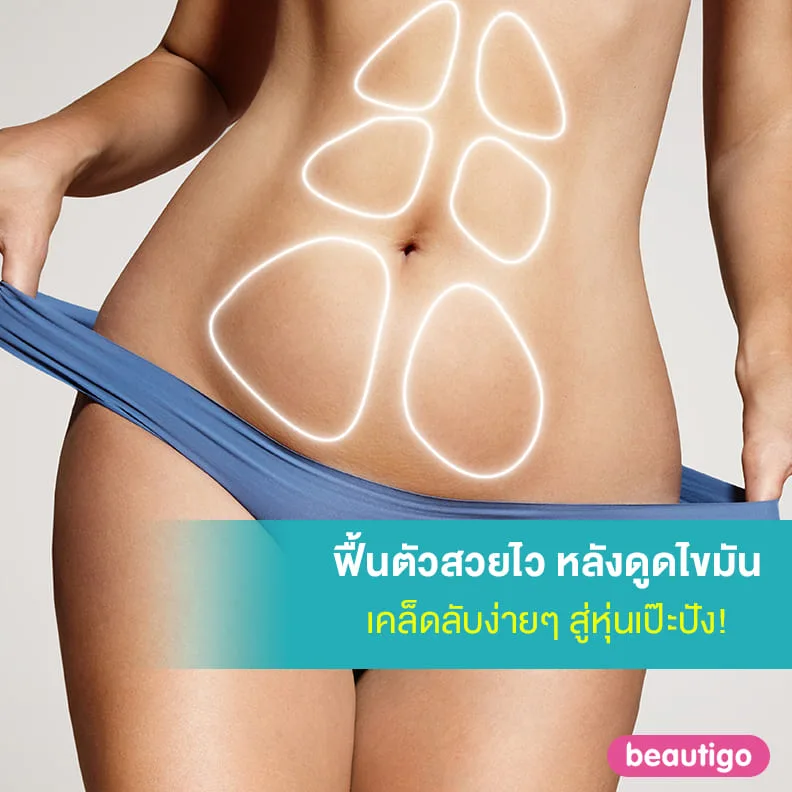 ฟื้นตัวสวยไว หลังดูดไขมัน เคล็ดลับง่ายๆ สู่หุ่นเป๊ะปัง!