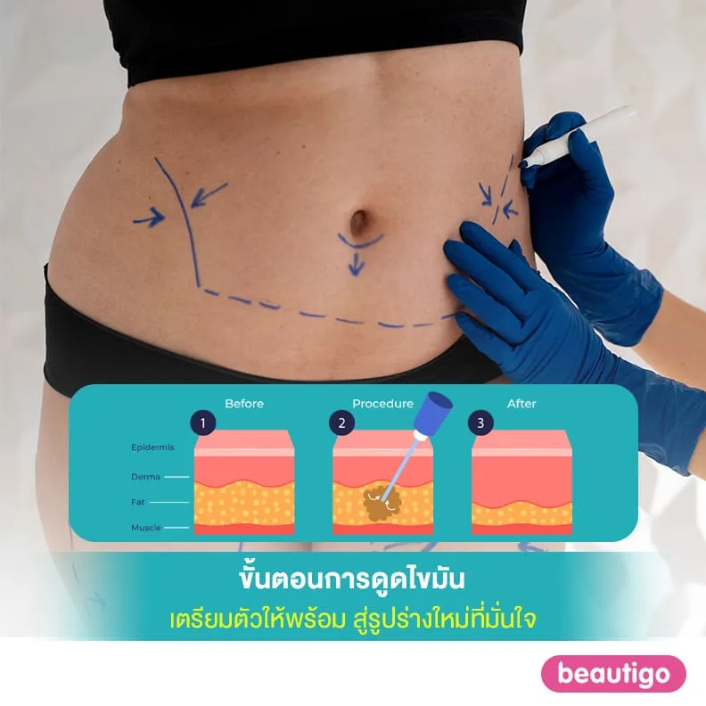 ขั้นตอนการดูดไขมัน เตรียมตัวให้พร้อม สู่รูปร่างใหม่ที่มั่นใจ
